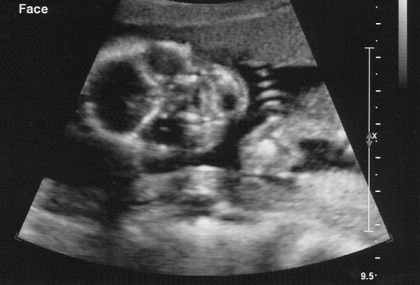 Aug in utero